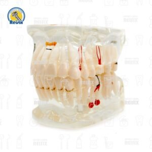 Tipodonto con Patologias: diente perdido, implante y caries